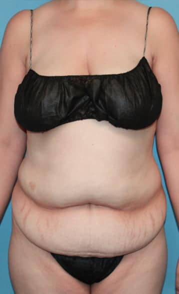 Tummy Tuck before photo front view - Dr. Cat Beverly Hills