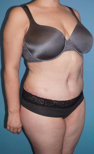 Tummy Tuck after photo - Dr. Cat Beverly Hills