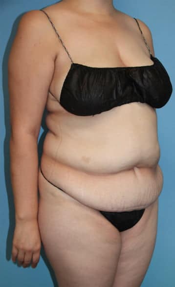 Tummy Tuck before photo - Dr. Cat Beverly Hills