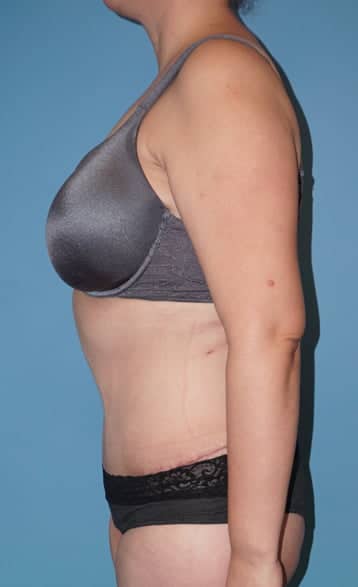 Tummy Tuck after photo side view - Dr. Cat Beverly Hills