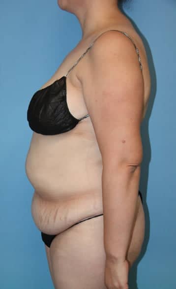 Tummy Tuck before photo side view - Dr. Cat Beverly Hills