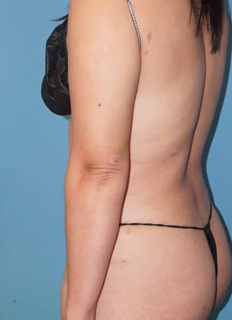 Revision Liposuction after photo - Dr. Cat Beverly Hills