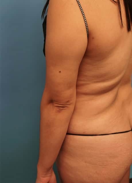 Revision Liposuction before photo - Dr. Cat Beverly Hills