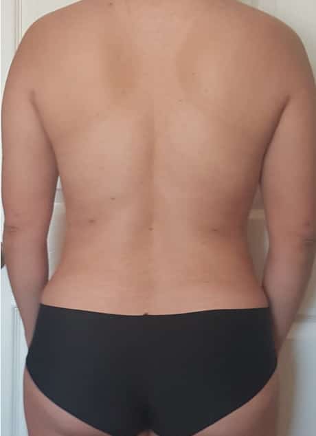 Revision Liposuction after photo - Dr. Cat Beverly Hills
