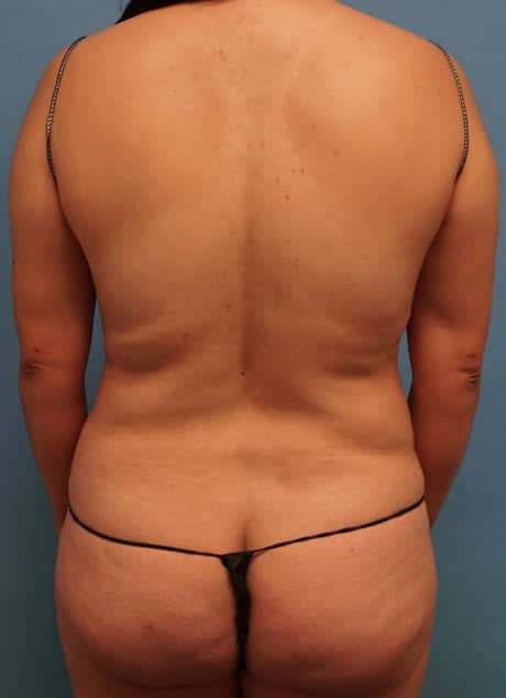 Revision Liposuction before photo - Dr. Cat Beverly Hills