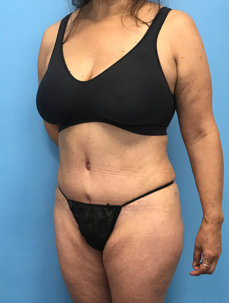 Angled view of a woman's body showing smoother, tighter abdominal contours following revision liposuction surgery.