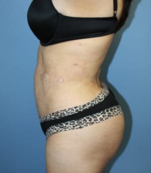 Revision Liposuction after photo - Dr. Cat Beverly Hills