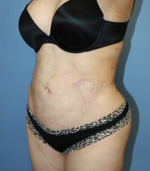 Revision Liposuction after photo - Dr. Cat Beverly Hills