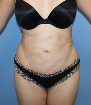 Revision Liposuction after photo - Dr. Cat Beverly Hills