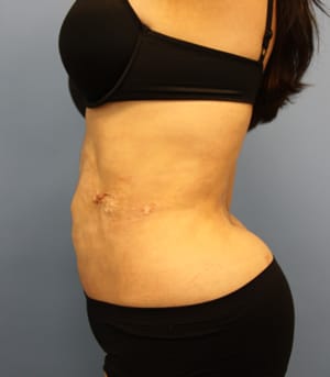 Revision Liposuction before photo - Dr. Cat Beverly Hills