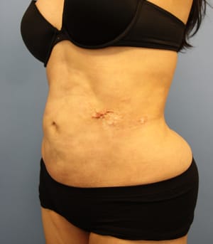 Revision Liposuction before photo - Dr. Cat Beverly Hills