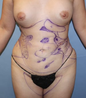 Revision Liposuction before photo - Dr. Cat Beverly Hills