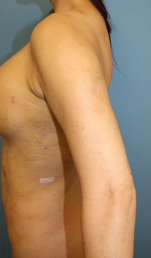 Revision Liposuction after photo - Dr. Cat Beverly Hills