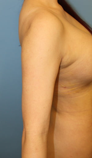 Revision Liposuction after photo - Dr. Cat Beverly Hills