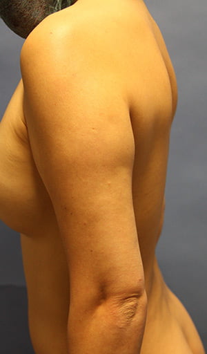 Revision Liposuction before photo - Dr. Cat Beverly Hills