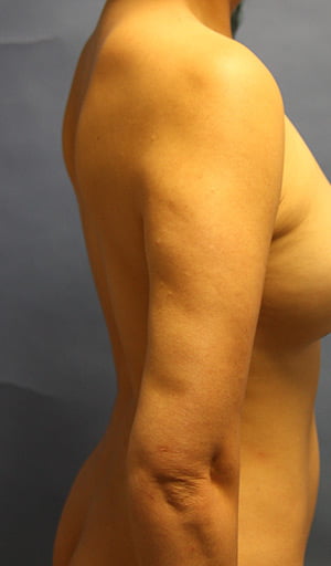 Revision Liposuction before photo - Dr. Cat Beverly Hills