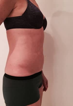 Revision Liposuction after photo - Dr. Cat Beverly Hills