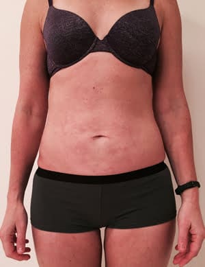 Revision Liposuction after photo - Dr. Cat Beverly Hills