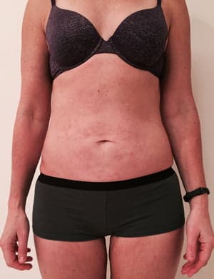 Revision Liposuction after photo - Dr. Cat Beverly Hills