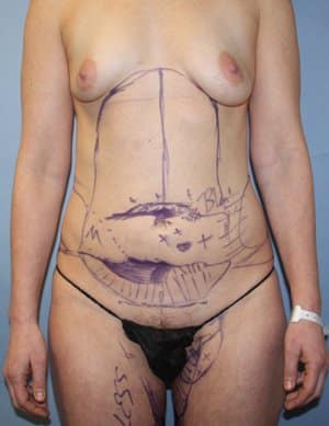 Revision Liposuction before photo - Dr. Cat Beverly Hills