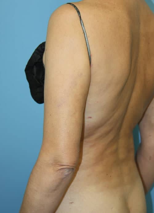 Revision Liposuction after photo - Dr. Cat Beverly Hills