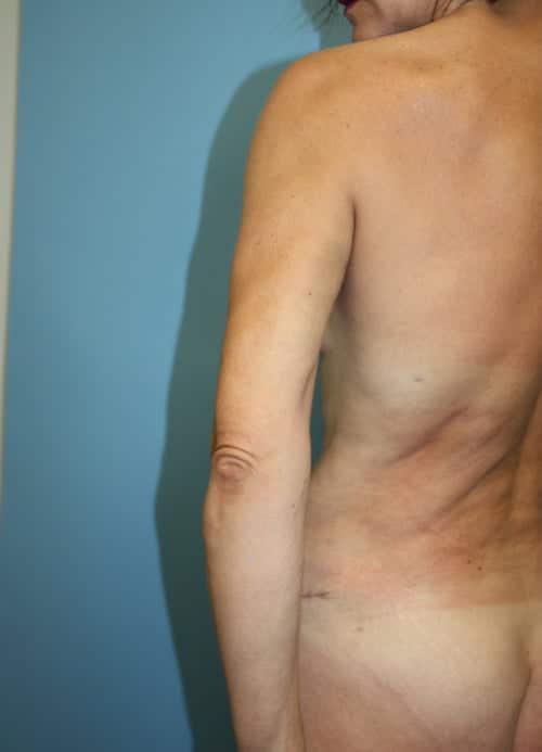 Revision Liposuction before photo - Dr. Cat Beverly Hills