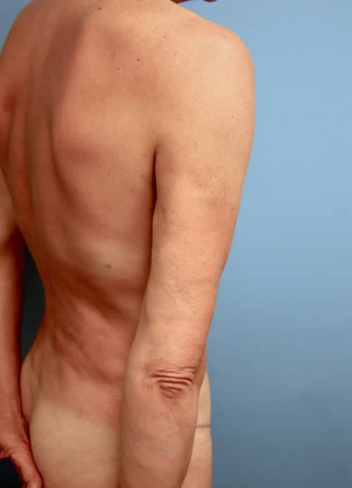 Revision Liposuction before photo - Dr. Cat Beverly Hills