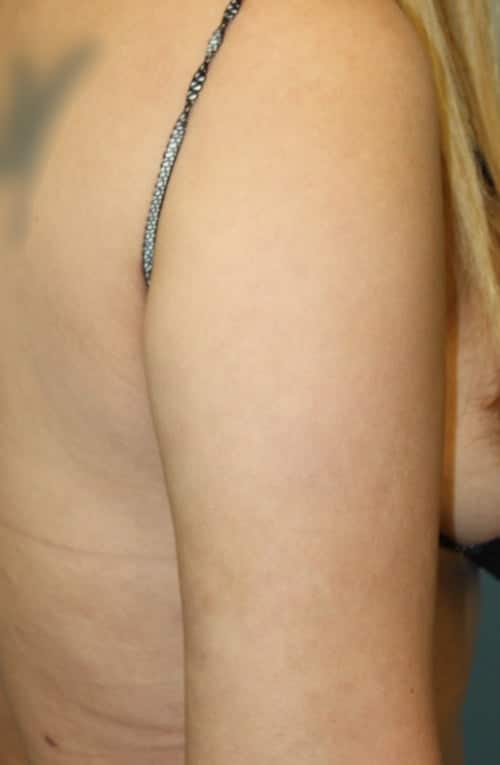Revision Liposuction after photo - Dr. Cat Beverly Hills