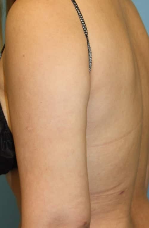 Revision Liposuction after photo - Dr. Cat Beverly Hills