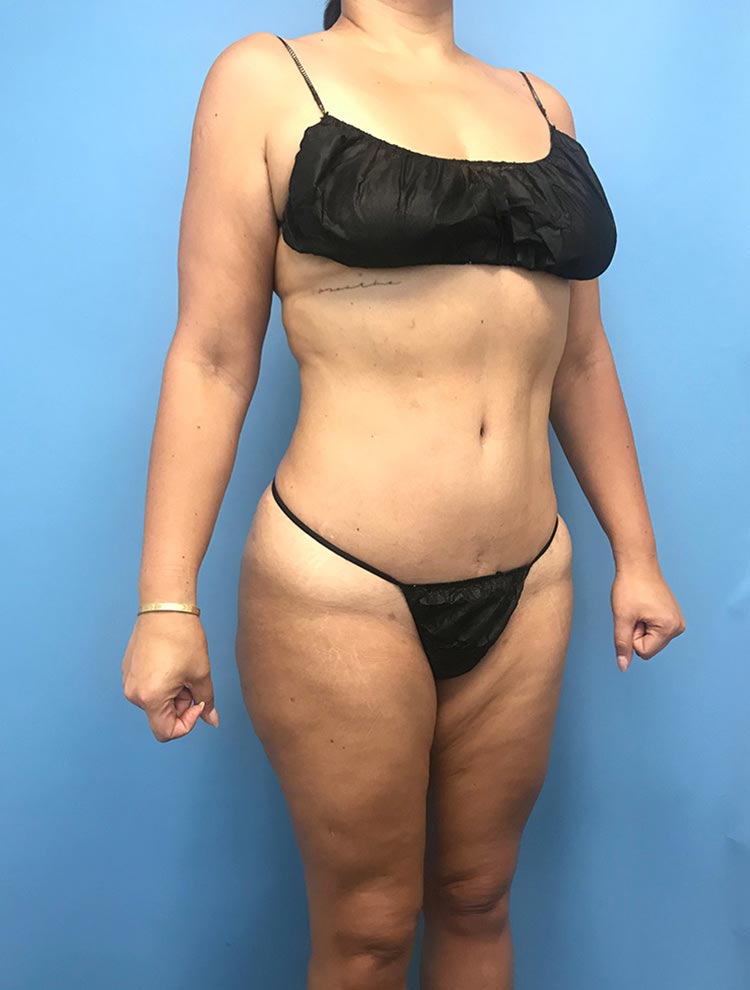 Patient showing side view after tummy tuck surgery, highlighting the improved contour of the abdomen and waist