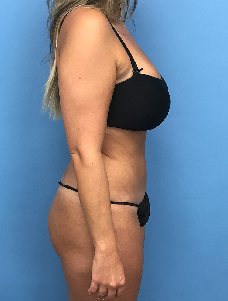 Side profile of a woman's abdomen illustrating results from revision tummy tuck surgery.