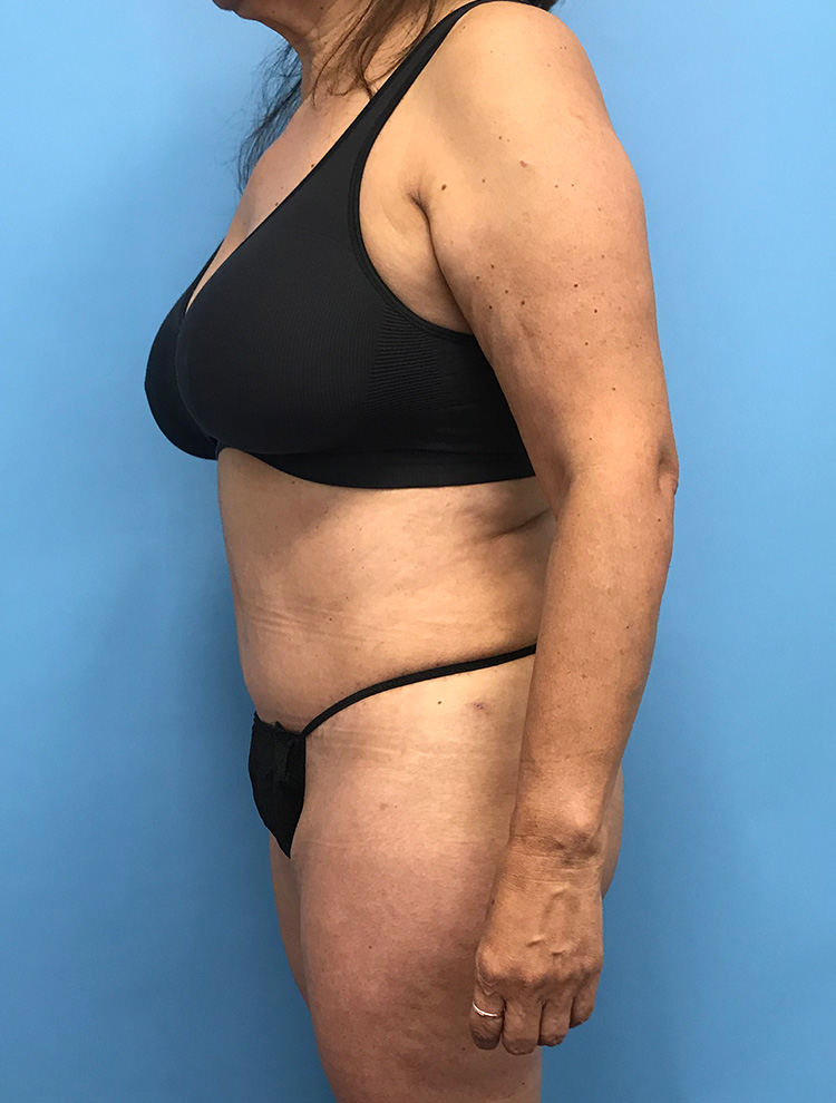 Side profile of a patient after revision tummy tuck surgery, showing a firm and contoured abdomen.