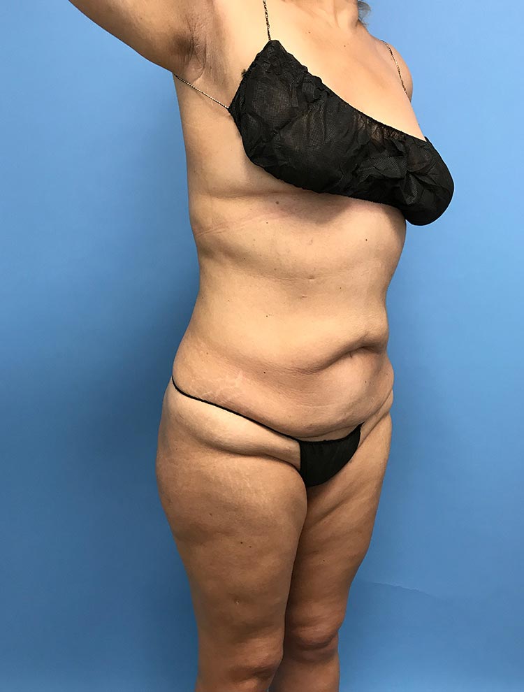 Before image of a tummy tuck procedure showing the side profile of the patient.