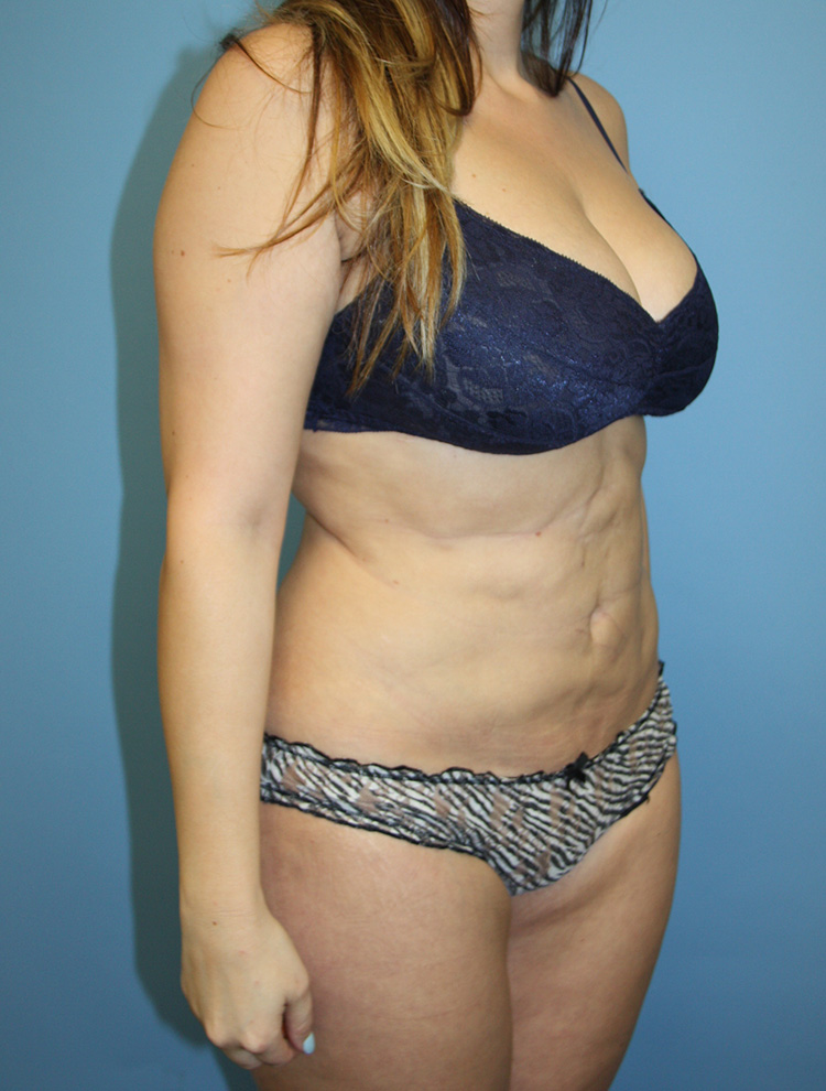 An angled side profile of a woman before undergoing revision tummy tuck surgery.