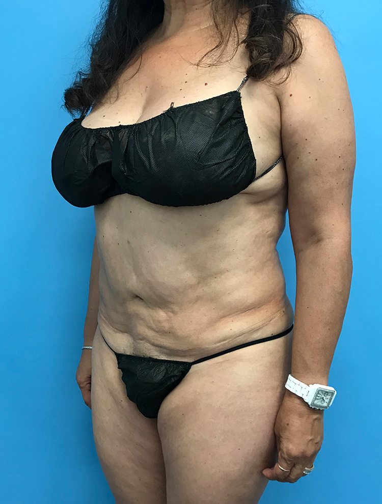 Angled pre-operative view of a woman's abdomen showing skin laxity and uneven contours before revision tummy tuck surgery.