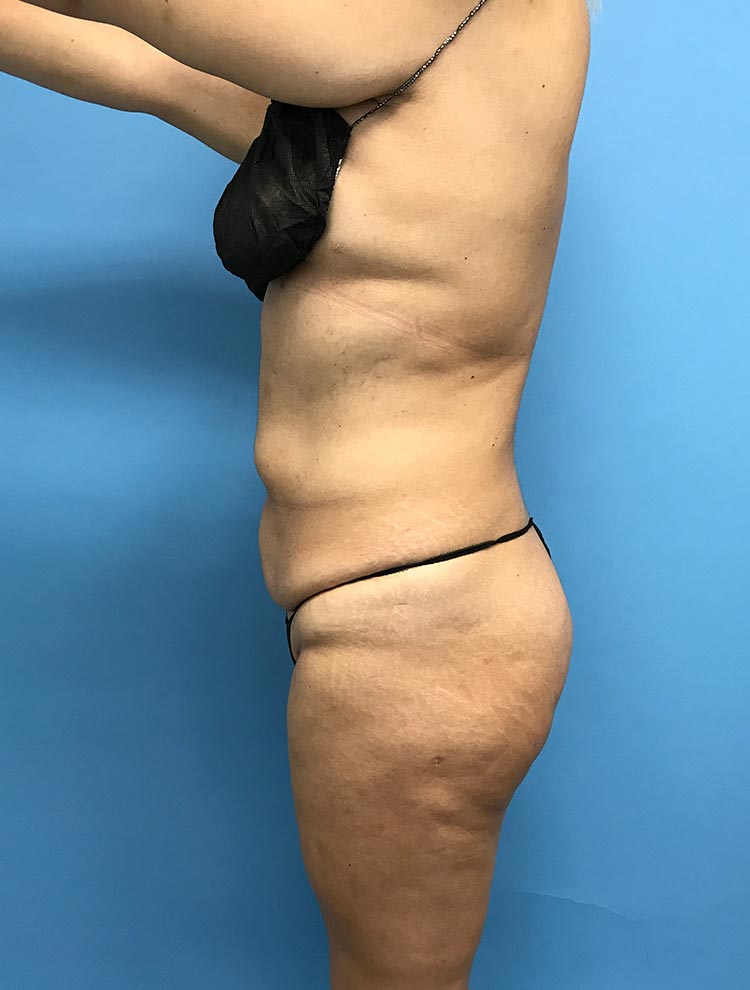 Side view of a woman before tummy tuck surgery, showcasing excess skin and abdominal area that will be improved with the procedure.