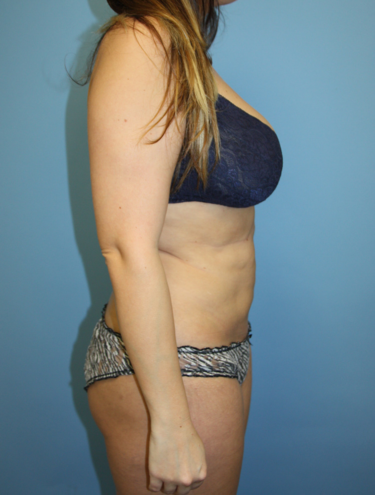 Side profile of a woman before undergoing revision tummy tuck surgery.