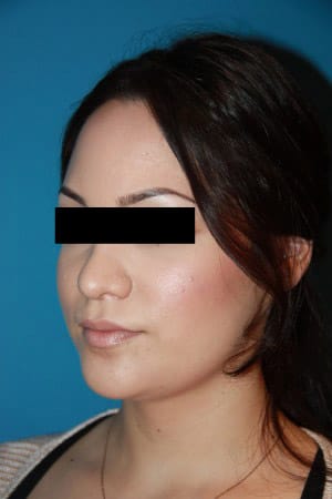 Rhinoplasty after photo - Dr. Cat Beverly Hills