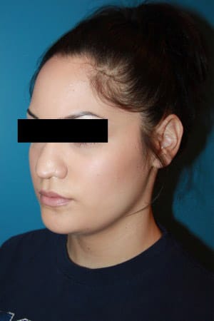 Rhinoplasty before photo - Dr. Cat Beverly Hills