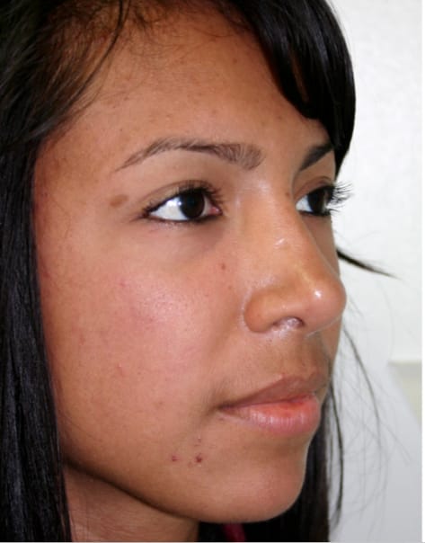 Rhinoplasty after photo - Dr. Cat Beverly Hills