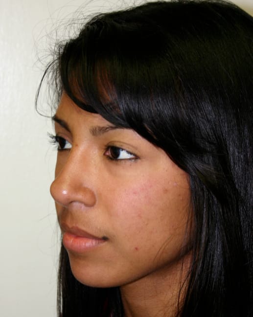 Rhinoplasty after photo - Dr. Cat Beverly Hills