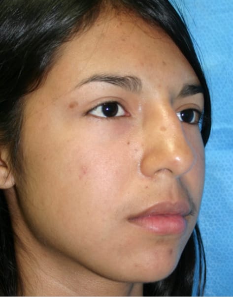 Rhinoplasty before photo - Dr. Cat Beverly Hills
