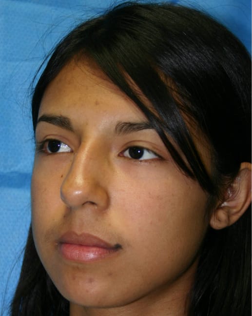 Rhinoplasty before photo - Dr. Cat Beverly Hills