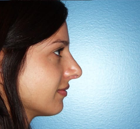 Rhinoplasty after photo - Dr. Cat Beverly Hills