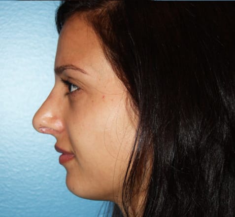 Rhinoplasty after photo - Dr. Cat Beverly Hills