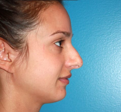 Rhinoplasty before photo - Dr. Cat Beverly Hills