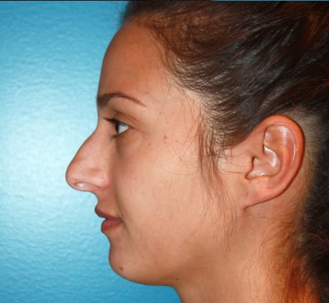 Rhinoplasty before photo - Dr. Cat Beverly Hills