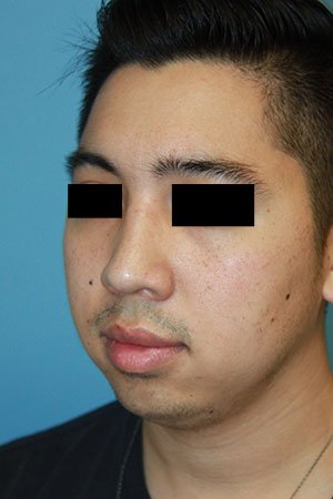 Rhinoplasty after photo - Dr. Cat Beverly Hills