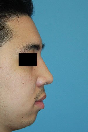 Rhinoplasty after photo - Dr. Cat Beverly Hills
