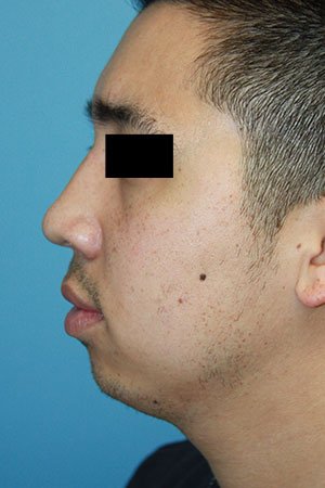 Rhinoplasty after photo - Dr. Cat Beverly Hills
